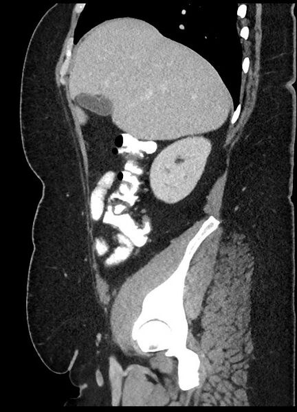 File:Carcinoid tumor - terminal ileum (Radiopaedia 60931-68739 C 77).jpg