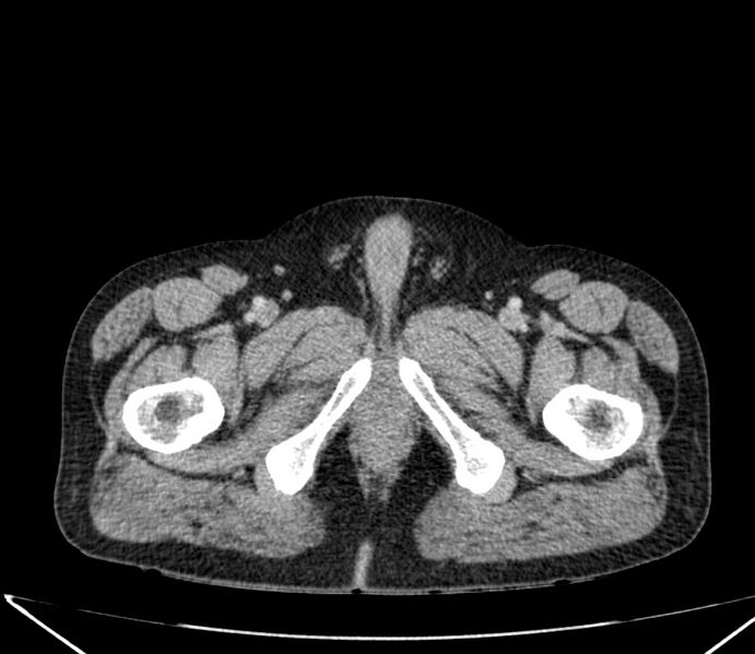 File:Carcinoid tumor with hepatic metastases (Radiopaedia 22651-22670 C 81).jpg
