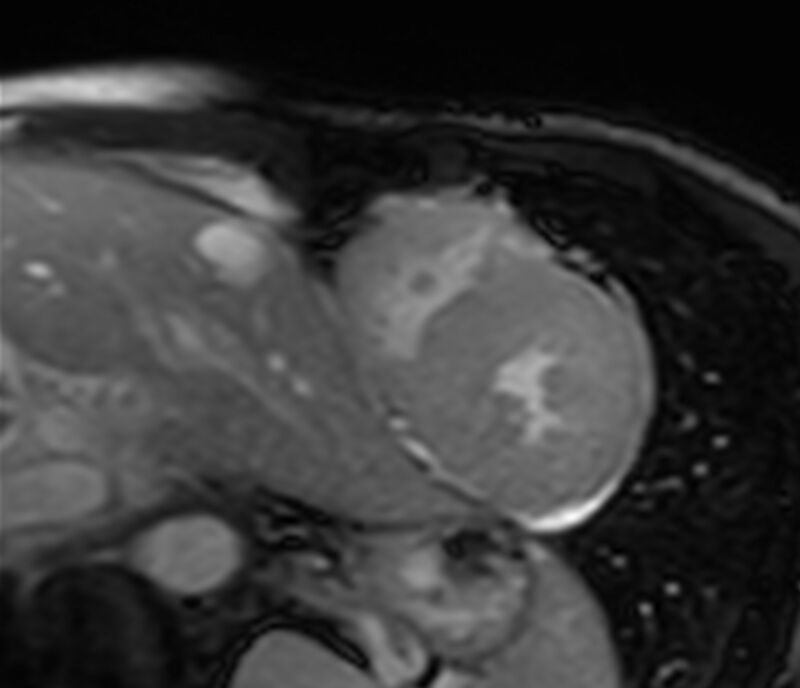 Cardiac amyloidosis (Radiopaedia 39736-42124 F 182).jpg
