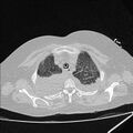Cardiogenic pulmonary edema (Radiopaedia 29213-29609 Axial lung window 12).jpg