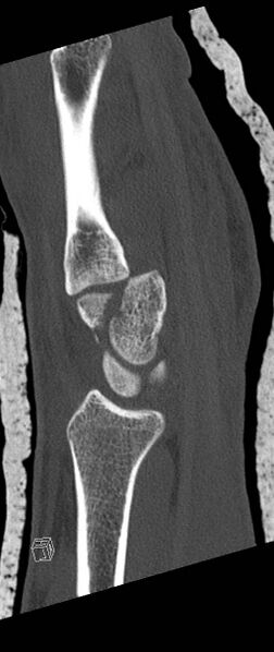 File:Carpal fractures (smart watch impaction) (Radiopaedia 55844-62430 Sagittal bone window 24).jpg