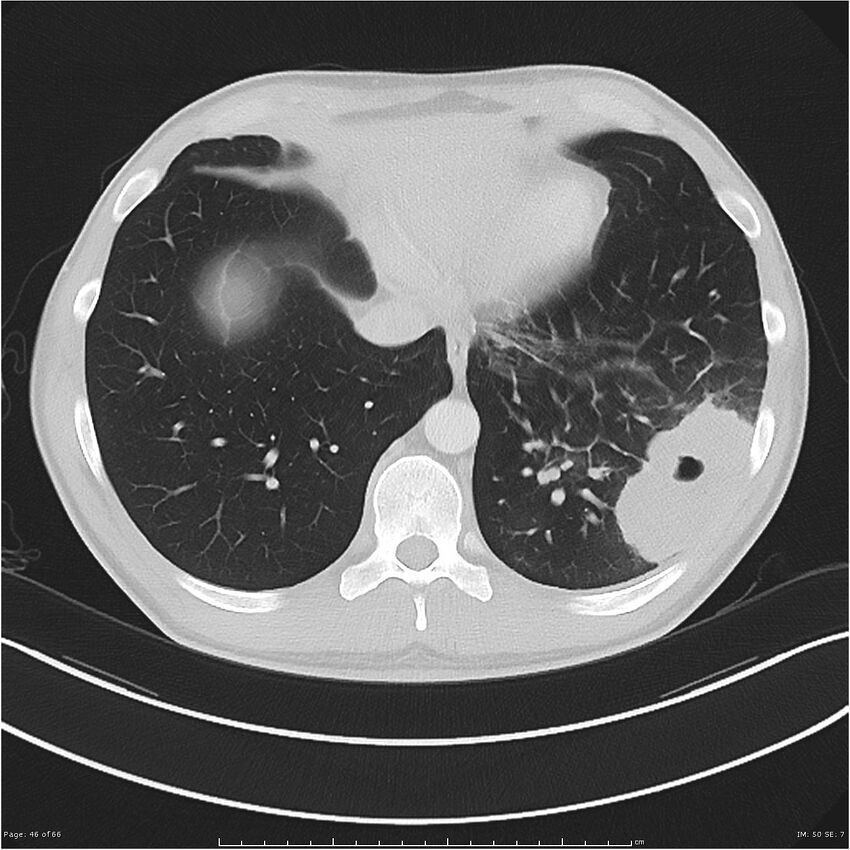 Cavitating lung cancer (Radiopaedia 25796-25945 Axial lung window 46).jpg