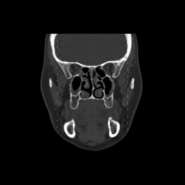 File:Cemento-ossifying fibroma (Radiopaedia 21243-21149 Coronal bone window 11).jpg