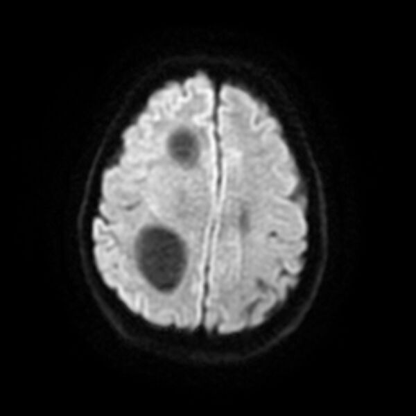 File:Central neurocytoma (Radiopaedia 67618-77021 Axial DWI 17).jpg