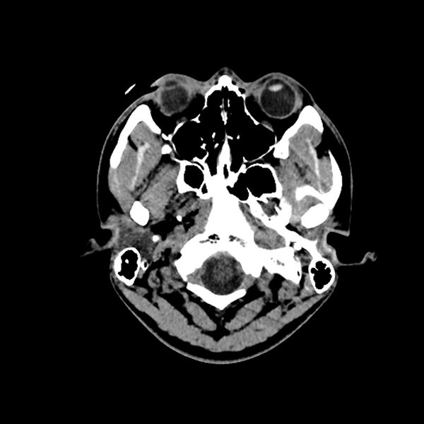 File:Central neurocytoma (Radiopaedia 79320-92379 Axial non-contrast 3).jpg