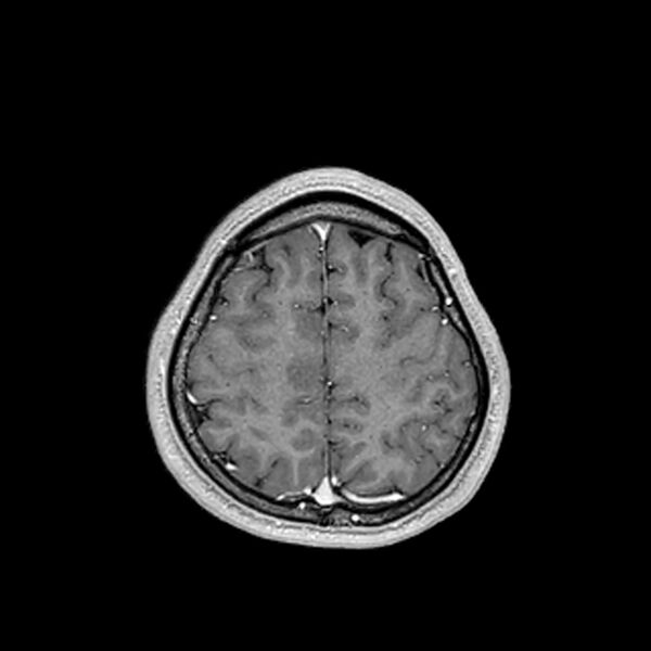 File:Central neurocytoma (Radiopaedia 79320-92380 Axial T1 C+ 193).jpg