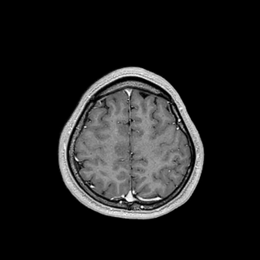 Central neurocytoma (Radiopaedia 79320-92380 Axial T1 C+ 193).jpg
