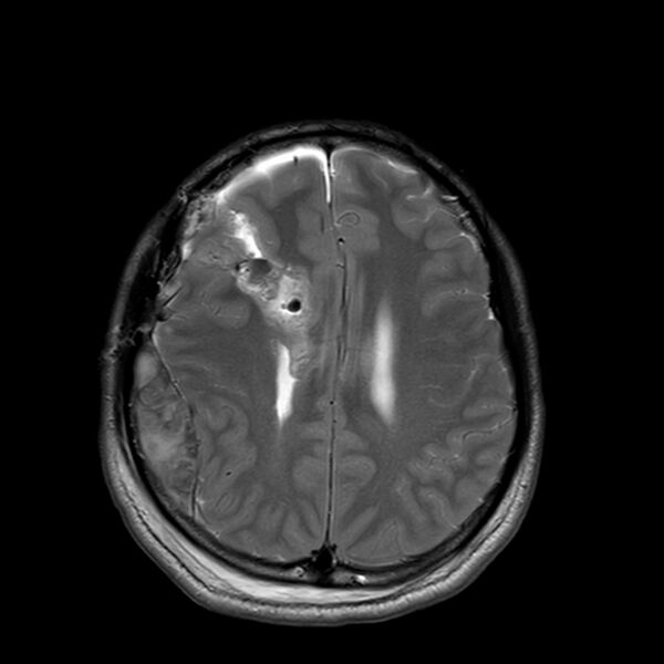 File:Central neurocytoma (Radiopaedia 79320-92381 Axial T2 19).jpg