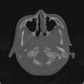 Cerebellar abscess secondary to mastoiditis (Radiopaedia 26284-26413 Axial bone window 16).jpg