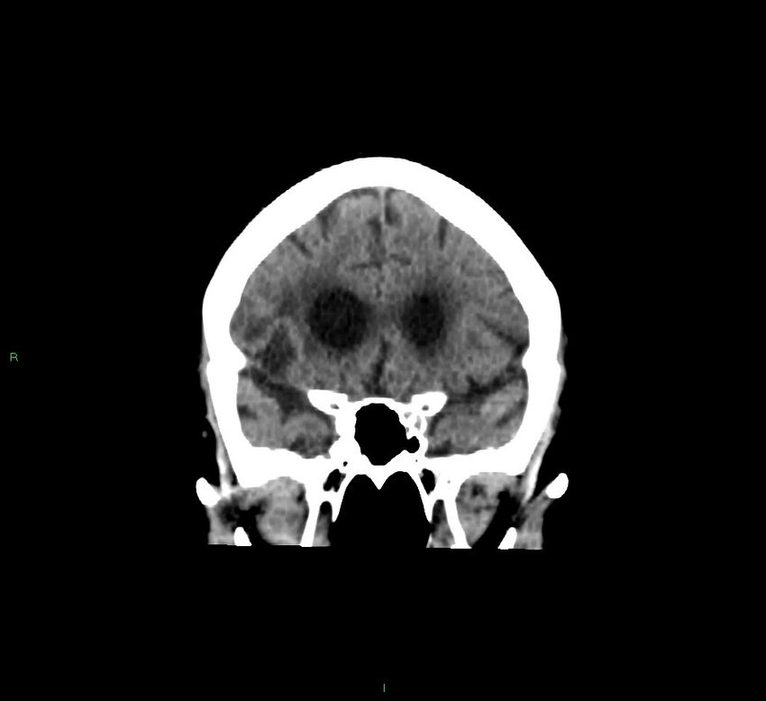 Cerebellar hemorrhage (Radiopaedia 58793-66027 Coronal non-contrast 47).jpg