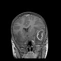 Cerebral abscess post cardiac surgery (Radiopaedia 27244-27420 Coronal T1 C+ 7).jpg