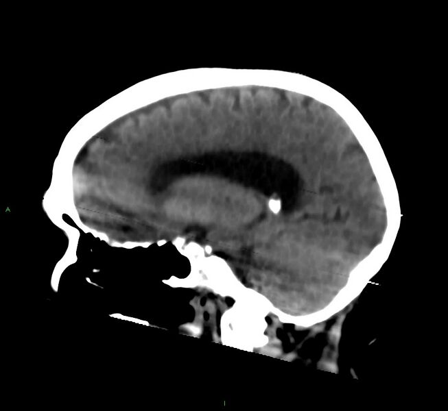 File:Cerebral amyloid angiopathy-associated lobar intracerebral hemorrhage (Radiopaedia 58377-65514 B 31).jpg