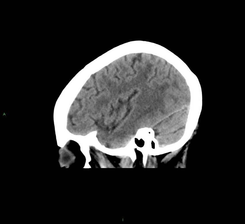 Cerebral amyloid angiopathy-associated lobar intracerebral hemorrhage (Radiopaedia 58378-65516 C 39).jpg