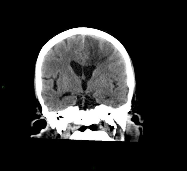 File:Cerebral amyloid angiopathy-associated lobar intracerebral hemorrhage (Radiopaedia 58529-65681 Coronal non-contrast 36).jpg