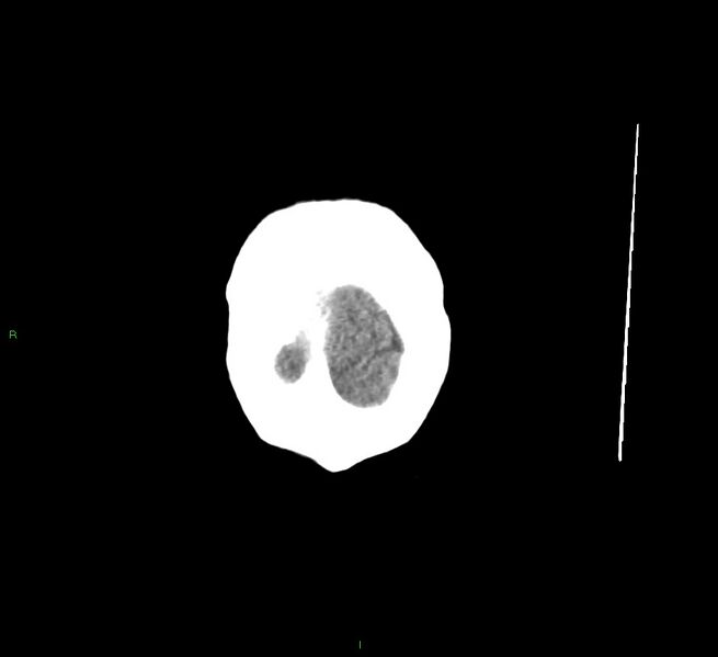 File:Cerebral amyloid angiopathy-associated lobar intracerebral hemorrhage (Radiopaedia 58529-65681 Coronal non-contrast 6).jpg