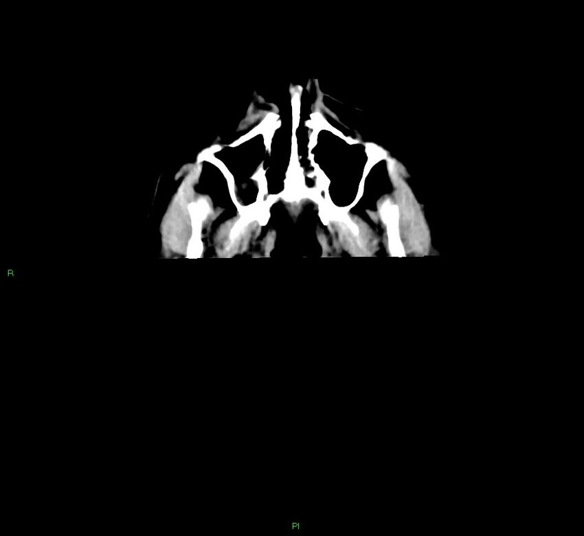 Cerebral amyloid angiopathy-associated lobar intracerebral hemorrhage (Radiopaedia 58756-65977 Axial non-contrast 53).jpg