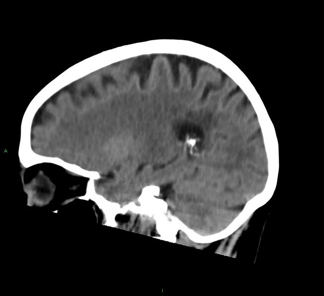 File:Cerebral amyloid angiopathy-associated lobar intracerebral hemorrhage (Radiopaedia 58757-65978 C 20).jpg