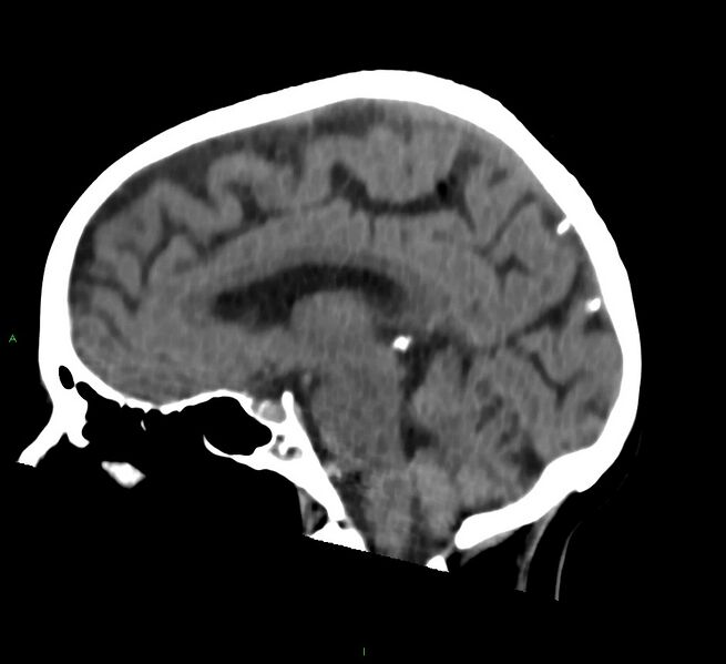 File:Cerebral amyloid angiopathy-associated lobar intracerebral hemorrhage (Radiopaedia 58757-65978 C 29).jpg