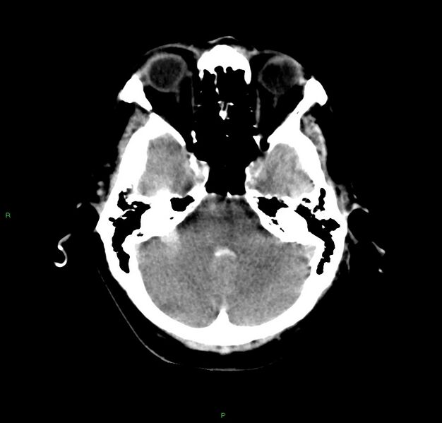File:Cerebral amyloid angiopathy-associated lobar intracerebral hemorrhage (Radiopaedia 59356-66716 Axial non-contrast 36).jpg