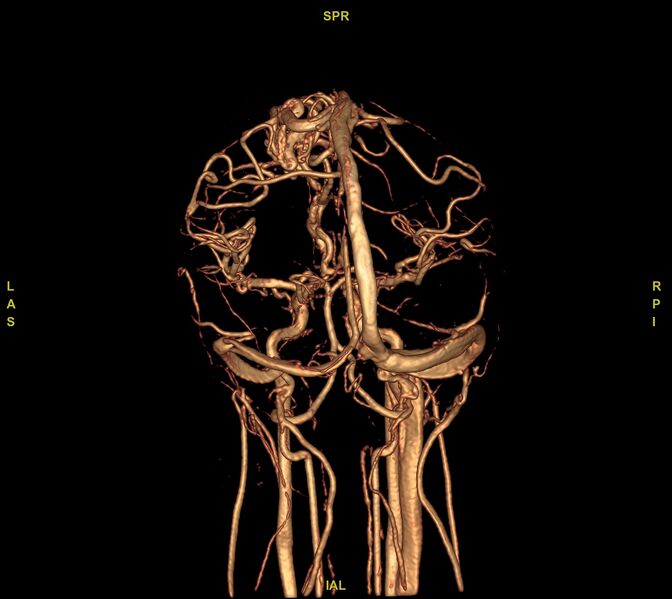 File:Cerebral arteriovenous malformation (Radiopaedia 61964-70029 VRT 14).jpg