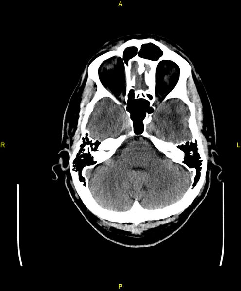 File:Cerebral autosomal dominant arteriopathy with subcortical infarcts and leukoencephalopathy (CADASIL) (Radiopaedia 86108-102051 Axial non-contrast 25).jpg