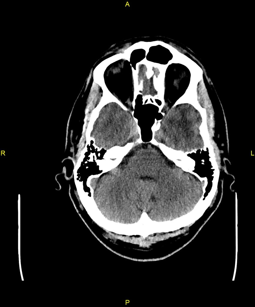 Cerebral autosomal dominant arteriopathy with subcortical infarcts and leukoencephalopathy (CADASIL) (Radiopaedia 86108-102051 Axial non-contrast 25).jpg