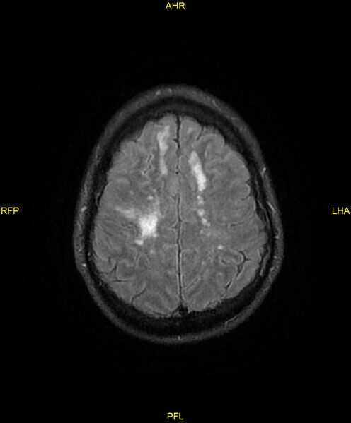File:Cerebral autosomal dominant arteriopathy with subcortical infarcts and leukoencephalopathy (CADASIL) (Radiopaedia 86108-102054 Axial FLAIR 23).jpg