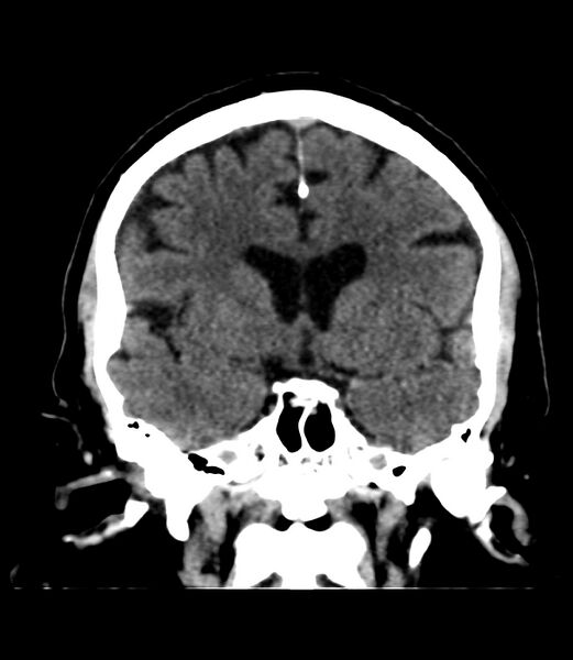 File:Cerebral dural venous sinus thrombosis (Radiopaedia 86514-102575 Coronal non-contrast 20).jpg