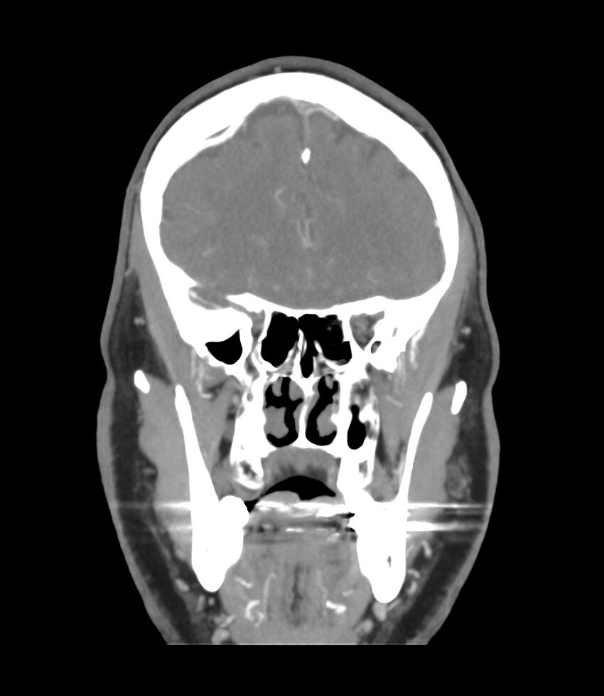 Cerebral dural venous sinus thrombosis (Radiopaedia 86514-102576 B 15).jpg