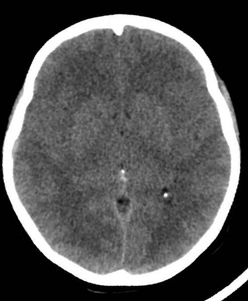 File:Cerebral edema due to severe hyponatremia (Radiopaedia 89826-106937 Axial non-contrast 44).jpg