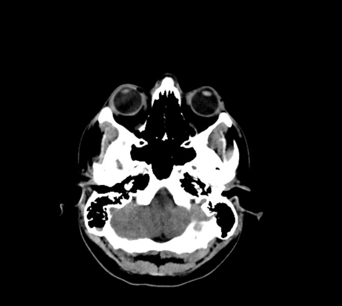 File:Cerebral fat embolism (Radiopaedia 37510-39362 Axial non-contrast 8).jpg
