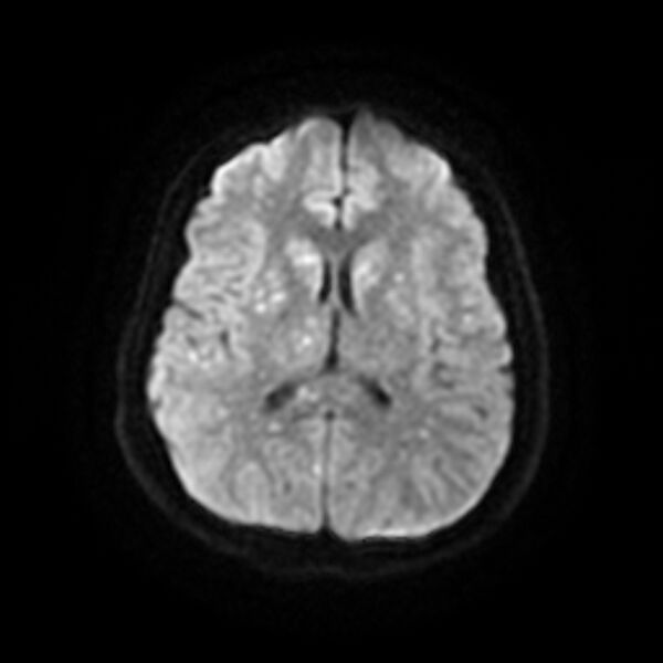 File:Cerebral fat embolism (Radiopaedia 37510-39363 Axial DWI 16).jpg