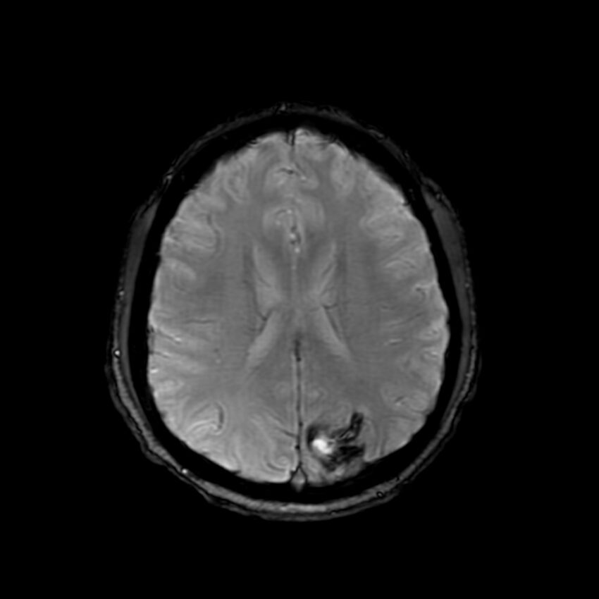 Cerebral paragonimiasis (Radiopaedia 73473-84238 Axial SWI 44).jpg