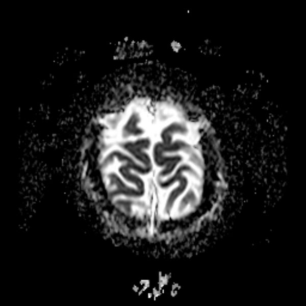 File:Cerebral tuberculoma (Radiopaedia 41152-43932 Axial ADC 22).jpg