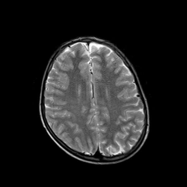 File:Cerebral tuberculoma (Radiopaedia 41152-43932 Axial T2 16).jpg