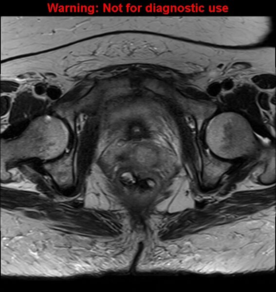 File:Cervical cancer (Radiopaedia 24151-24410 Axial T2 23).jpg