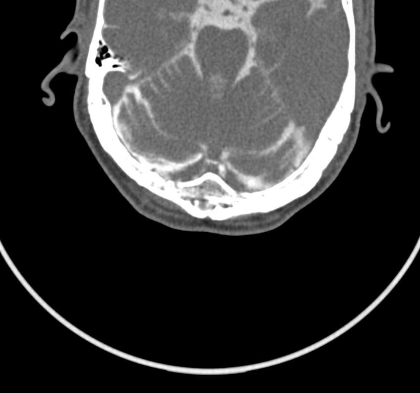 Cervical dural CSF leak on MRI and CT treated by blood patch (Radiopaedia 49748-54996 B 2).png