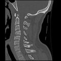 Cervical flexion teardrop fracture with cord hemorrhage (Radiopaedia 32497-33454 Sagittal bone window 24).jpg