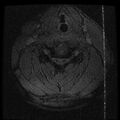 Cervical flexion teardrop fracture with cord hemorrhage (Radiopaedia 32497-33455 Axial Gradient Echo 16).jpg
