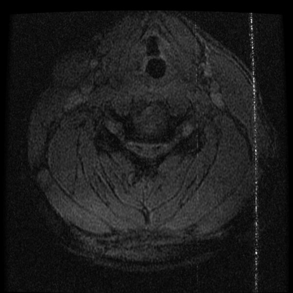 File:Cervical flexion teardrop fracture with cord hemorrhage (Radiopaedia 32497-33455 Axial Gradient Echo 16).jpg