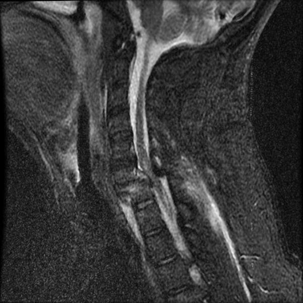 File:Cervical fracture and dislocation with locked facet (Radiopaedia 31837-32781 Sagittal STIR 7).jpg