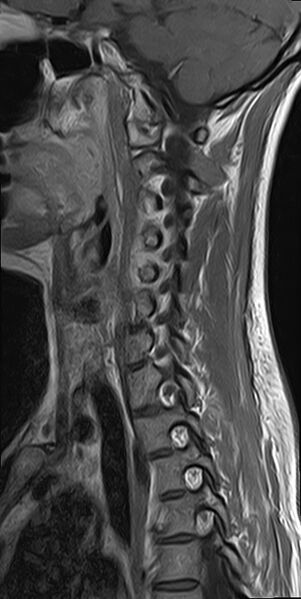 File:Cervical spondylodiscitis and calvarial hemangioma (Radiopaedia 64317-73104 Sagittal T1 C+ 4).jpg