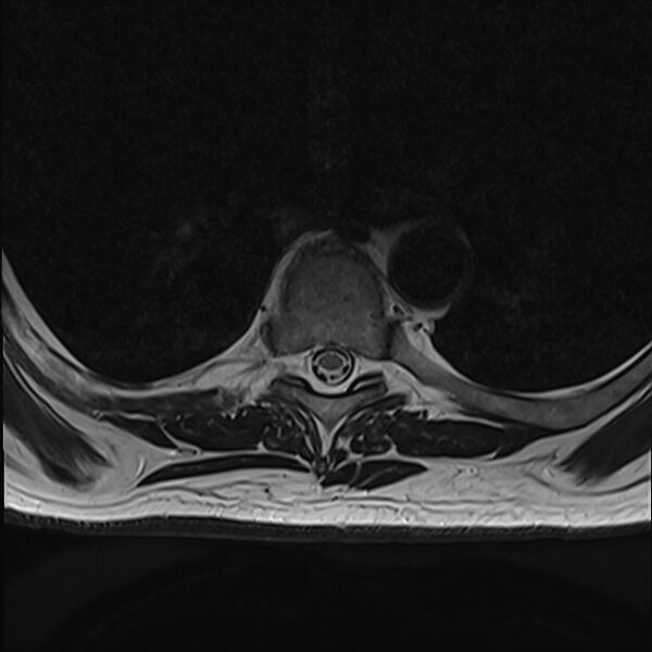 File:Cervical tumor-like myelopathy due to Type V dAVF (Radiopaedia 82461-96604 D 26).jpg
