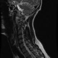 Cervical vertebrae metastasis (Radiopaedia 78814-91667 Sagittal T2 9).png