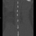 Chance fracture (Radiopaedia 36521-38081 Coronal bone window 65).jpg