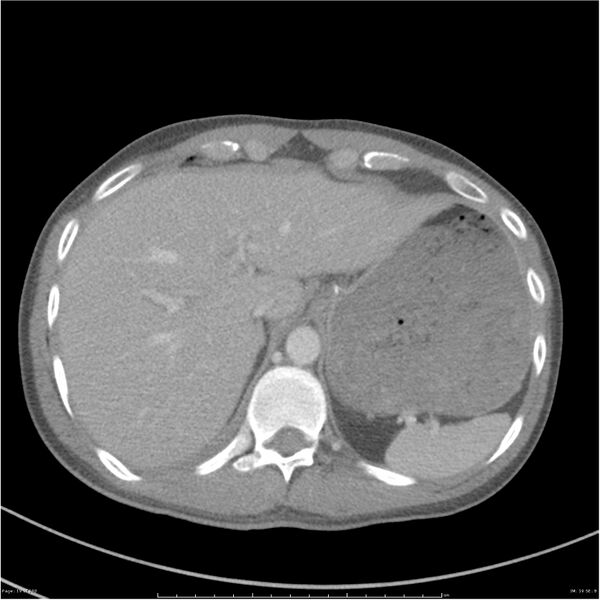 File:Chest and abdomen multi-trauma (Radiopaedia 26294-26426 bone window 19).jpg