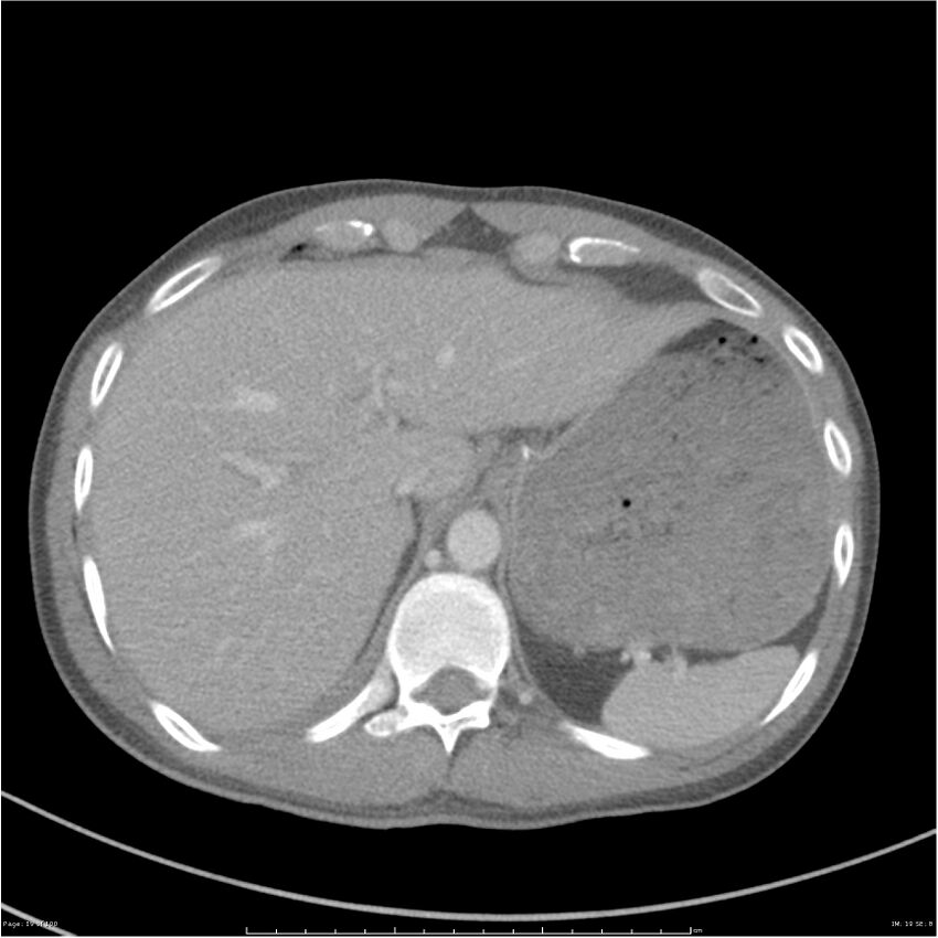 Chest and abdomen multi-trauma (Radiopaedia 26294-26426 bone window 19).jpg