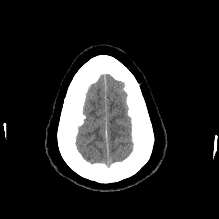 Chiasmatic-hypothalamic juvenile pilocytic astrocytoma (Radiopaedia 78533-91237 Axial non-contrast 51).jpg