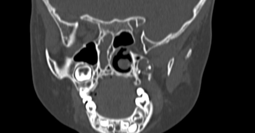 Choanal atresia (Radiopaedia 51295-56972 Coronal bone window 61).jpg