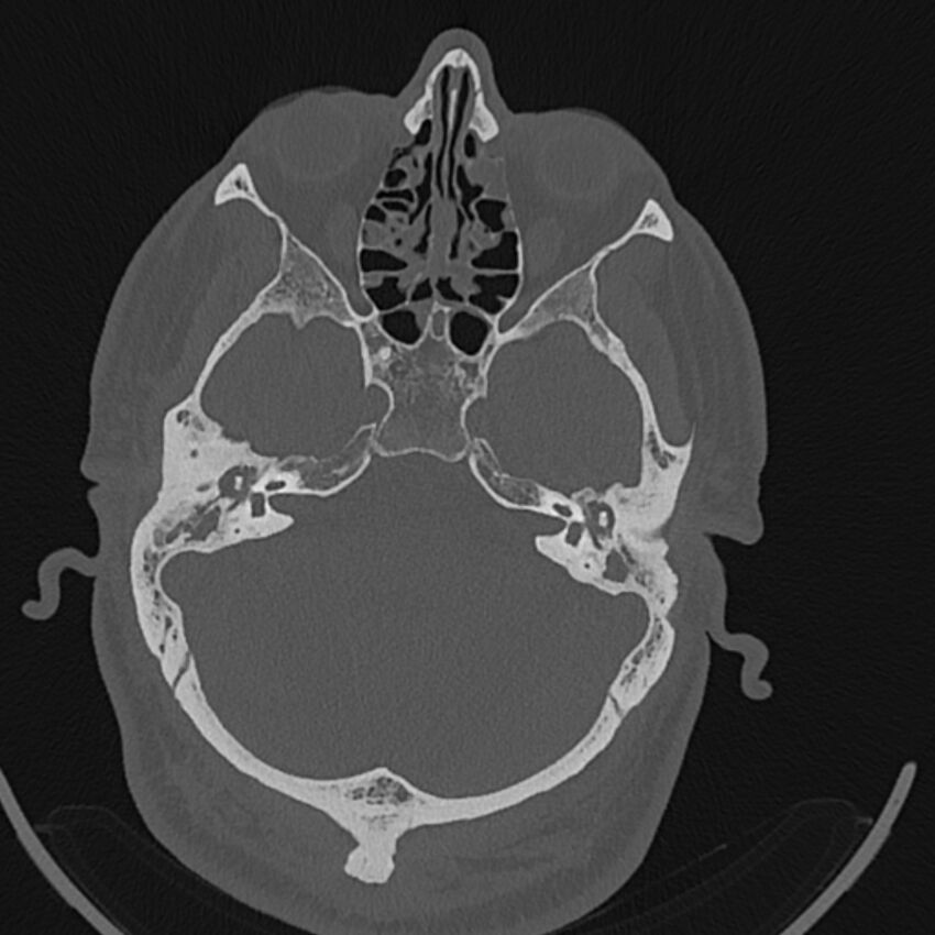 Cholesteatoma (Radiopaedia 68176-77673 Axial bone window 46).jpg